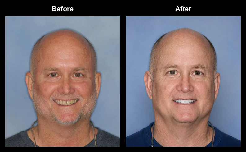 Smile makeover before and after, Creating Beautiful Smiles, Melbourne FL