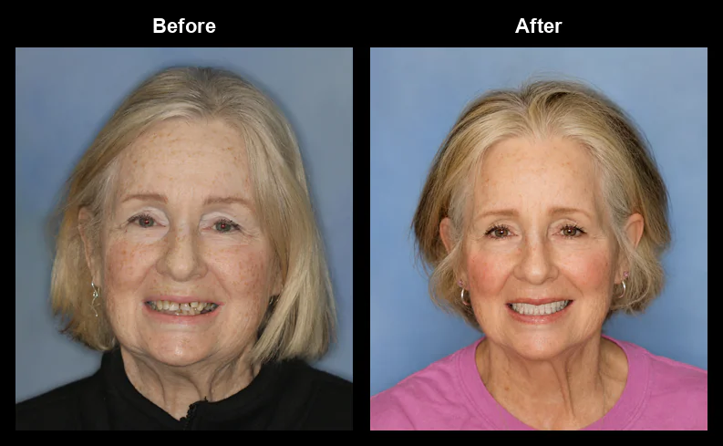 Smile makeover before and after, Creating Beautiful Smiles, Melbourne FL